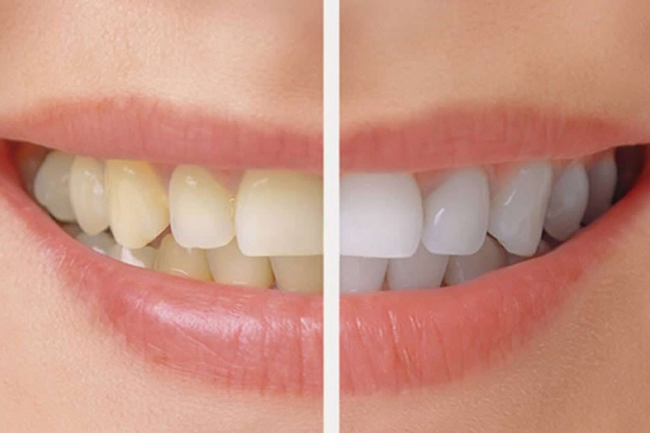 tooth whitening clinic in moosapet